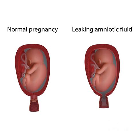 leaking amniotic fluid look like|Leaking Amniotic Fluid: How to Tell